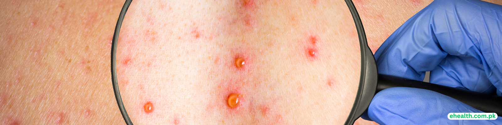 Chickenpox (Varicella)